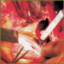 Тактика хирургического лечения инфекционного эндокардита  у больных с неклапанными врожденными пороками сердца