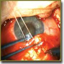 Применение полимерного микрошунта оригинальной конструкции  в хирургическом лечении больных открытоугольной глаукомой	