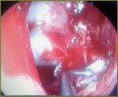 Spontaneous Liquorrhea Nasalis When Skull Base Defect is Located in Sphenoidal Sinus