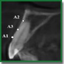 Сохранение костного и мягкотканного компонентов альвеолярного гребня при немедленной имплантации в эстетической зоне челюстей в условиях дефицита костной ткани