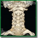 Radiological Diagnostic Technique Selection in Early Cervical Lateral Stenosis
