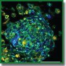 3D-модель опухолевого сфероида из краткосрочных культур клеток глиобластомы пациента и ее исследование методом метаболического флуоресцентного времяразрешенного имиджинга