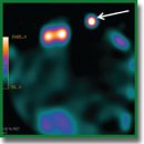 Методика сцинтиграфической визуализации воспалительных процессов в стенке аорты с использованием <sup>99m</sup>Тc-пирофосфата