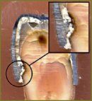 Изучение с помощью срезов состояния твердых тканей зубов, покрытых искусственными коронками, в отдаленные сроки  после протезирования
