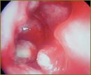 Удаление ретинированного 18-го зуба из верхнечелюстной пазухи эндоскопическим доступом