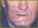 Пластика сквозных дефектов челюстно-лицевой области у онкологических больных