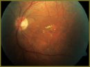 Использование оптической когерентной томографии  для исследования эффективности лечения больных  с диабетической ретинопатией препаратом Пиявит 