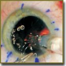 Факоэмульсификация катаракты у пациентов, перенесших переднюю радиальную кератотомию