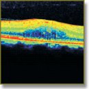 Применение оптической когерентной томографии для оценки результатов лечения диабетического макулярного отека с помощью лазеркоагуляции тканей глазного дна и интравитреального введения ранибизумаба (Луцентиса)