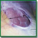 Laparoscopic Cholecystectomy Optimization: Partial Incision of Falciform Hepatic Ligament