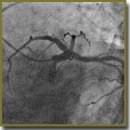 Применение чрескожной окклюзии венозного синуса сердца у больных с острым коронарным синдромом без гемодинамически значимого атеросклеротического поражения венечных артерий