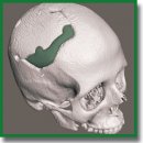 Костнозамещающие имплантаты из материала «Рекост-М» на основе 3D-моделирования для закрытия посттрепанационных дефектов черепа: доклинические и клинические исследования