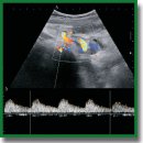 Shear Wave Ultrasound Elastography to Evaluate the State of Renal Transplant