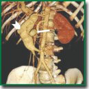 Эндоваскулярная окклюзия гигантской ложной посттравматической аневризмы верхней брыжеечной артерии, связанной с мезентериальной артериовенозной фистулой