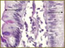 The Assessment Criteria of Morphological Changes of Duodenal Mucosa in Gastroduodenitis in Follow-up