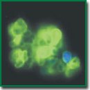 Biochip-SER Test System for Fluorescent Immunocytochemical Analysis of Ep-CAM Antigen Expression in Effusions and Washes