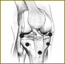 Температурная реакция тканей коленного сустава  в послеоперационном периоде при внутрисуставных переломах мыщелков большеберцовой кости