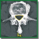 Закрытая остеотомия и удлинение ножек позвонков при стенозе поясничного отдела позвоночника: хирургическая техника (пилотное клиническое исследование)