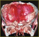 The Characteristics of Management of Concomitant Craniofacial Injury Complicated by Cerebrospinal Fluid Rhinorrhea