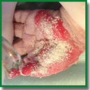 Биопластический коллагеновый материал «Коллост» при лечении ожоговой травмы