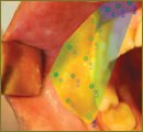 Диагностические возможности инфракрасной термографии  в обследовании больных с заболеваниями челюстно-лицевой  области