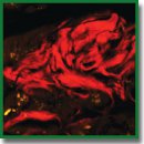 Новая технология выявления амилоида в тканях человека, основанная на использовании флуоресцентного красителя — аналога Конго красного