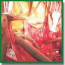 Денервация легочных артерий у пациентов с пороками митрального клапана, осложненными фибрилляцией предсердий и высокой легочной гипертензией