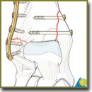 Современное оперативное лечение  переломов лодыжек и их последствий (обзор)
