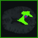 Efficiency of Kolmogorov–Arnold Networks in Small Medical Samples (Case Study of 2D Brain MRI Image Segmentation)