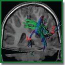 Individual Brain Tumor Invasion Mapping Based on Diffusion Kurtosis Imaging